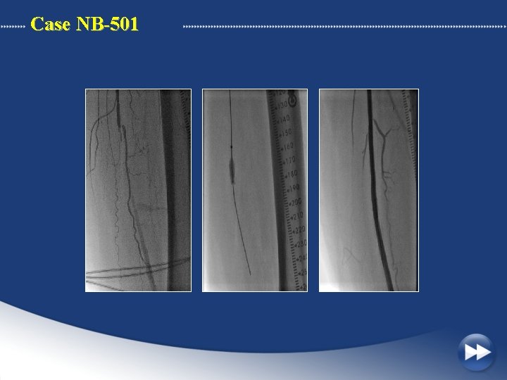 Case NB-501 