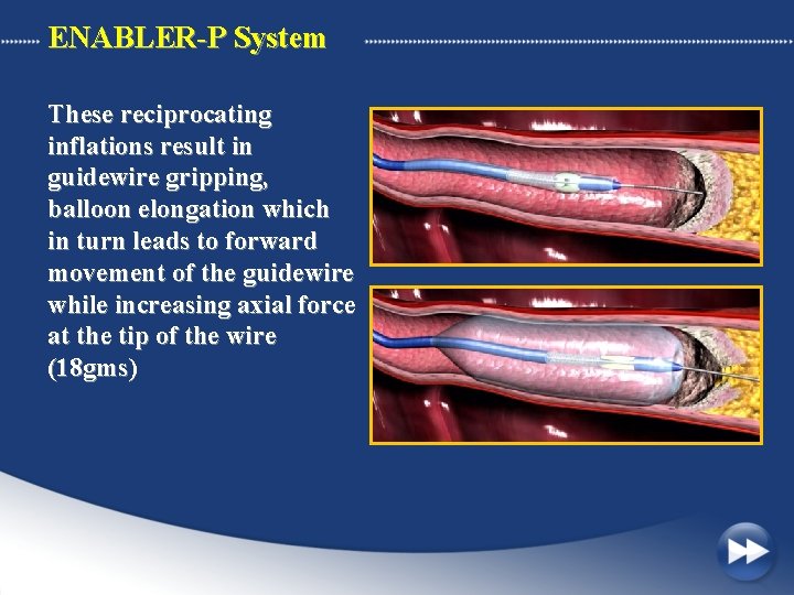 ENABLER-P System These reciprocating inflations result in guidewire gripping, balloon elongation which in turn