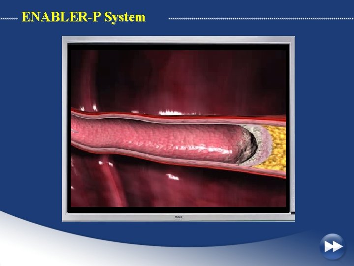 ENABLER-P System 