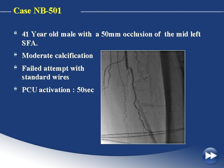 Case NB-501 41 Year old male with a 50 mm occlusion of the mid