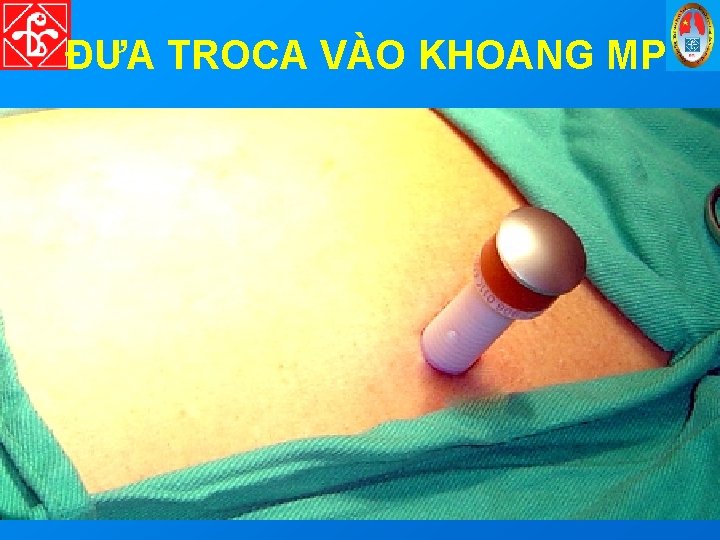 ĐƯA TROCA VÀO KHOANG MP 