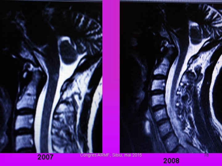 2007 Congres ARMF, Sibiu, mai 2015 2008 78 