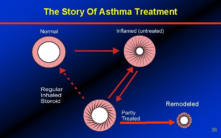 The Story Of Asthma Treatment Remodeled 36 