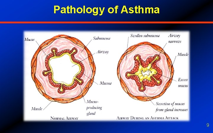 Pathology of Asthma 9 