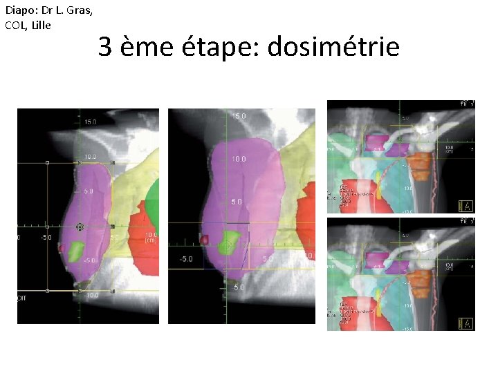 Diapo: Dr L. Gras, COL, Lille 3 ème étape: dosimétrie 