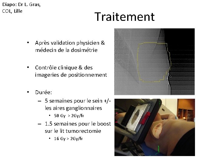 Diapo: Dr L. Gras, COL, Lille Traitement • Après validation physicien & médecin de