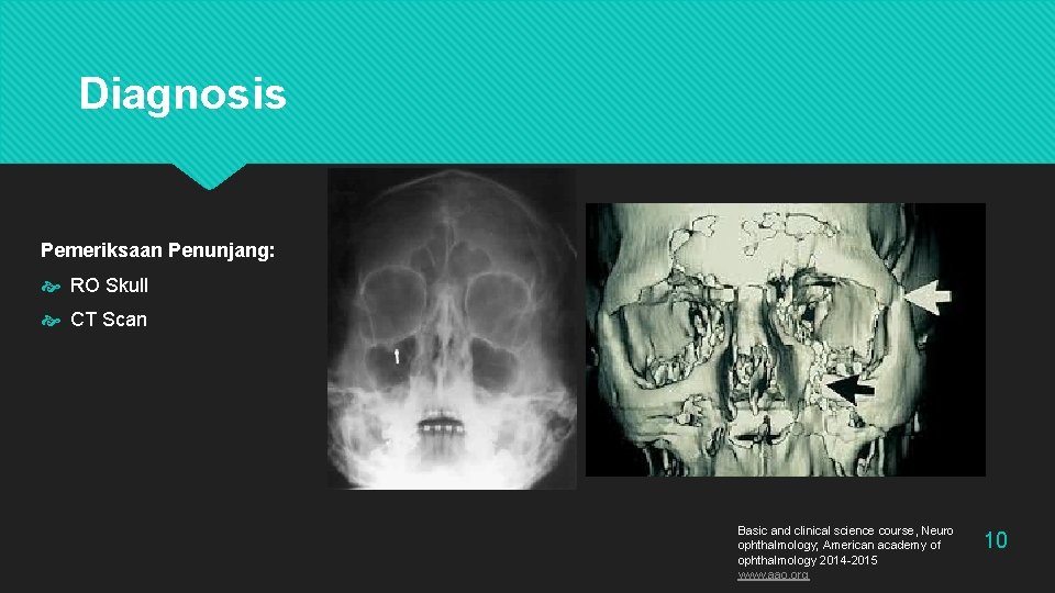 Diagnosis Pemeriksaan Penunjang: RO Skull CT Scan Basic and clinical science course, Neuro ophthalmology;