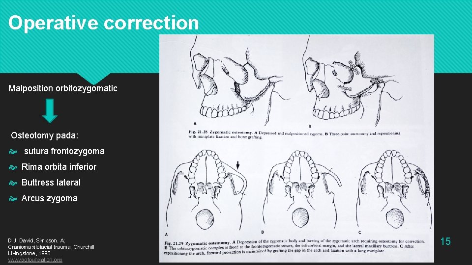 Operative correction Malposition orbitozygomatic Osteotomy pada: sutura frontozygoma Rima orbita inferior Buttress lateral Arcus