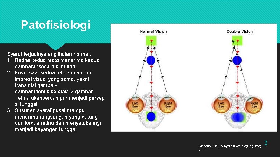 Patofisiologi Syarat terjadinya englihatan normal: 1. Retina kedua mata menerima kedua gambaransecara simultan 2.