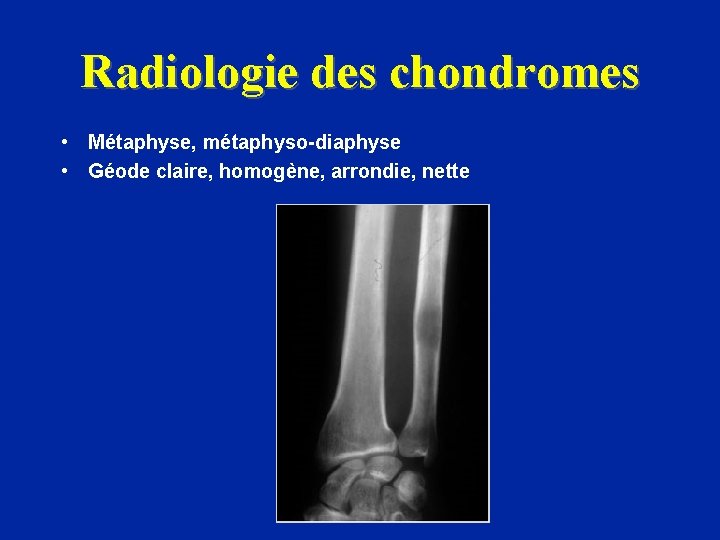 Radiologie des chondromes • Métaphyse, métaphyso-diaphyse • Géode claire, homogène, arrondie, nette 