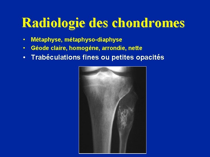 Radiologie des chondromes • Métaphyse, métaphyso-diaphyse • Géode claire, homogène, arrondie, nette • Trabéculations