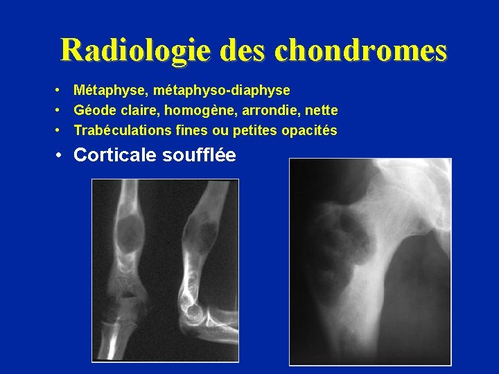 Radiologie des chondromes • Métaphyse, métaphyso-diaphyse • Géode claire, homogène, arrondie, nette • Trabéculations