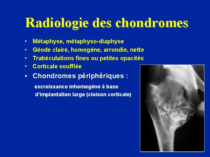 Radiologie des chondromes • • Métaphyse, métaphyso-diaphyse Géode claire, homogène, arrondie, nette Trabéculations fines