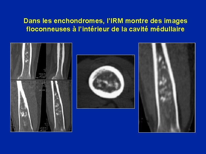 Dans les enchondromes, l’IRM montre des images floconneuses à l’intérieur de la cavité médullaire