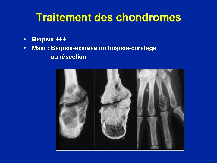 Traitement des chondromes • Biopsie +++ • Main : Biopsie-exérèse ou biopsie-curetage ou résection