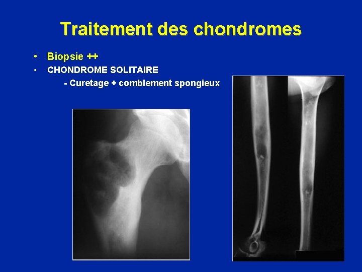 Traitement des chondromes • Biopsie ++ • CHONDROME SOLITAIRE - Curetage + comblement spongieux