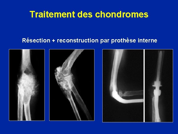 Traitement des chondromes Résection + reconstruction par prothèse interne 