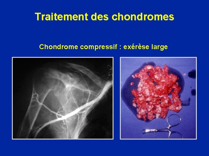 Traitement des chondromes Chondrome compressif : exérèse large 
