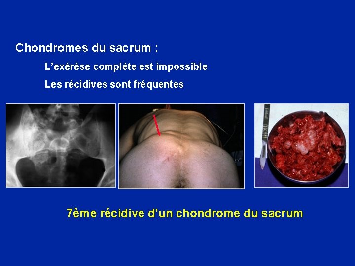 Chondromes du sacrum : L’exérèse complète est impossible Les récidives sont fréquentes 7ème récidive