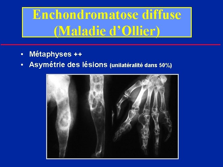 Enchondromatose diffuse (Maladie d’Ollier) • Métaphyses ++ • Asymétrie des lésions (unilatéralité dans 50%)