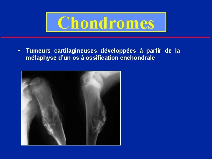 Chondromes • Tumeurs cartilagineuses développées à partir de la métaphyse d’un os à ossification