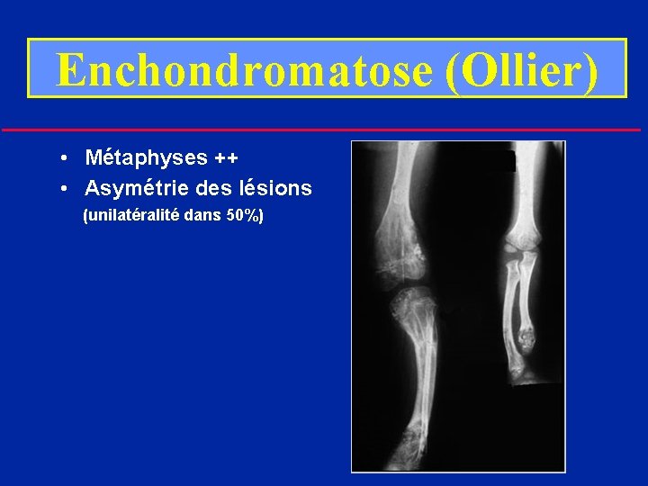 Enchondromatose (Ollier) • Métaphyses ++ • Asymétrie des lésions (unilatéralité dans 50%) 