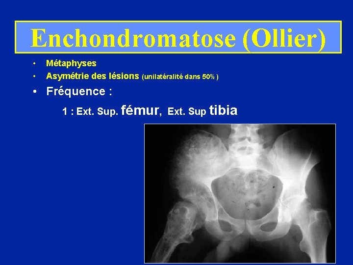 Enchondromatose (Ollier) • • Métaphyses Asymétrie des lésions (unilatéralité dans 50%) • Fréquence :