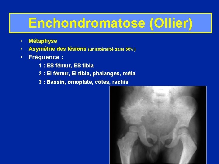 Enchondromatose (Ollier) • • Métaphyse Asymétrie des lésions (unilatéralité dans 50%) • Fréquence :