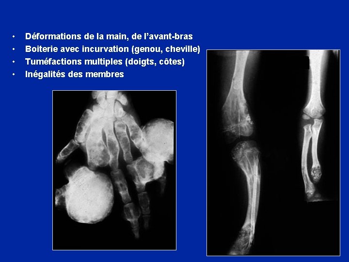  • • Déformations de la main, de l’avant-bras Boiterie avec incurvation (genou, cheville)