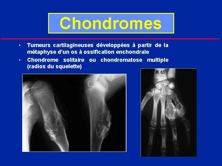 Chondromes • • Tumeurs cartilagineuses développées à partir de la métaphyse d’un os à