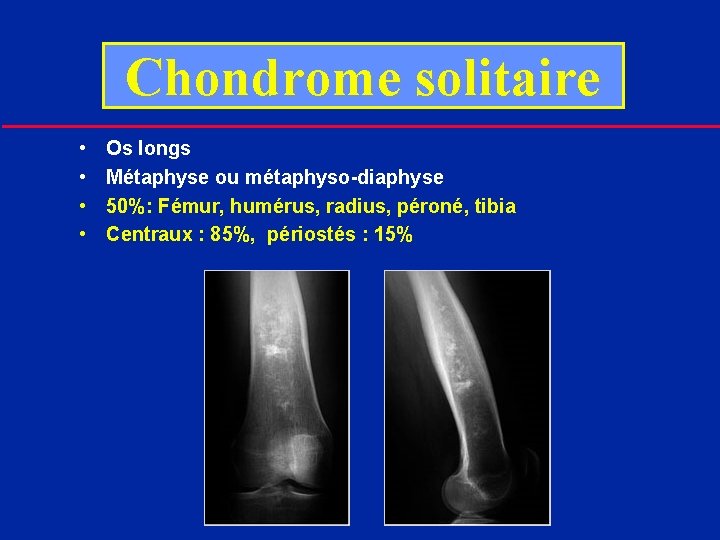Chondrome solitaire • • Os longs Métaphyse ou métaphyso-diaphyse 50%: Fémur, humérus, radius, péroné,