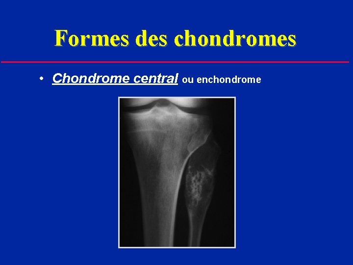 Formes des chondromes • Chondrome central ou enchondrome 
