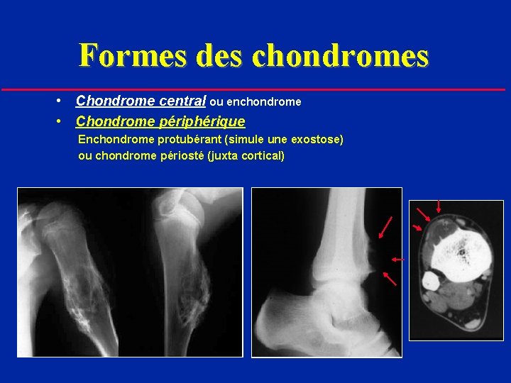 Formes des chondromes • Chondrome central ou enchondrome • Chondrome périphérique Enchondrome protubérant (simule
