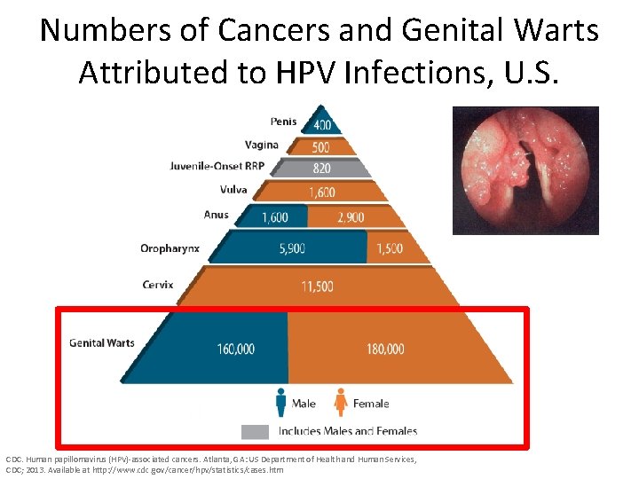 Numbers of Cancers and Genital Warts Attributed to HPV Infections, U. S. CDC. Human