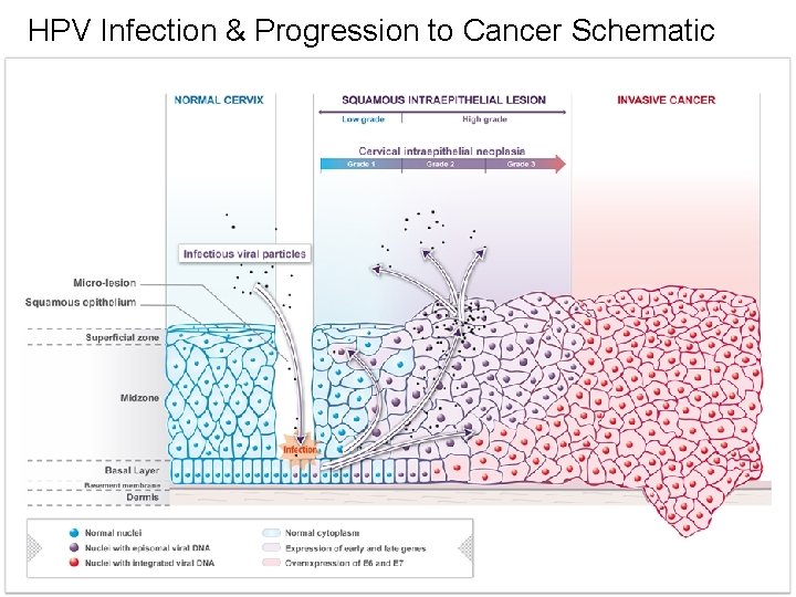 HPV Infection & Progression to Cancer Schematic 