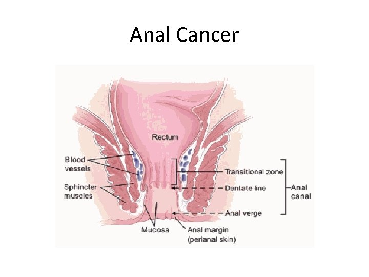 Anal Cancer 