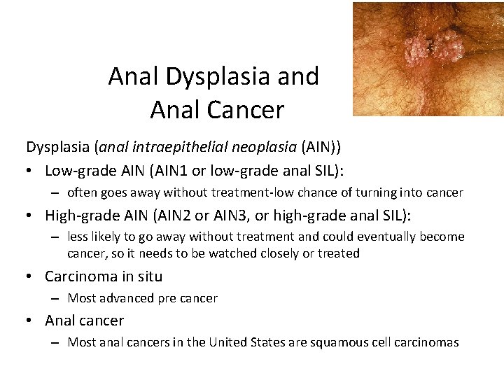 Anal Dysplasia and Anal Cancer Dysplasia (anal intraepithelial neoplasia (AIN)) • Low-grade AIN (AIN