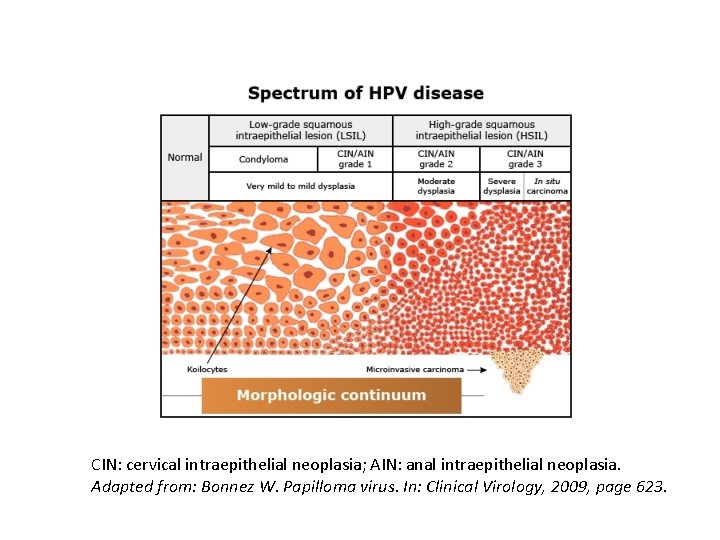 CIN: cervical intraepithelial neoplasia; AIN: anal intraepithelial neoplasia. Adapted from: Bonnez W. Papilloma virus.