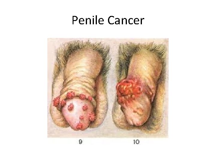 Penile Cancer 