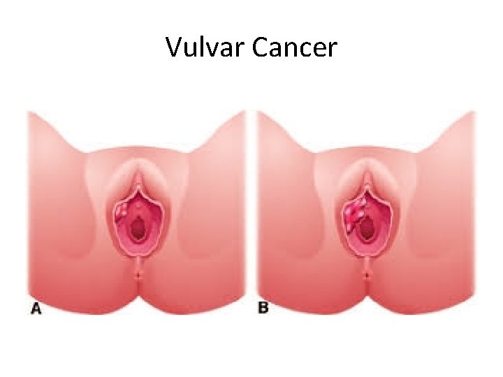 Vulvar Cancer 