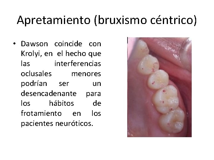 Apretamiento (bruxismo céntrico) • Dawson coincide con Krolyi, en el hecho que las interferencias