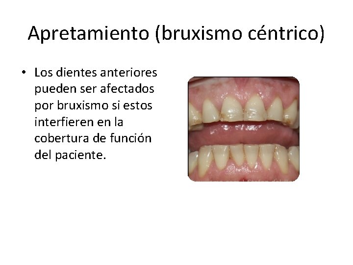 Apretamiento (bruxismo céntrico) • Los dientes anteriores pueden ser afectados por bruxismo si estos