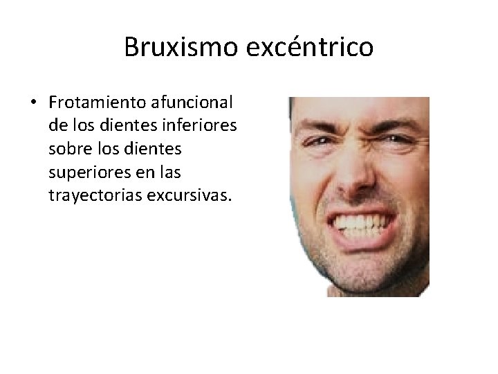 Bruxismo excéntrico • Frotamiento afuncional de los dientes inferiores sobre los dientes superiores en