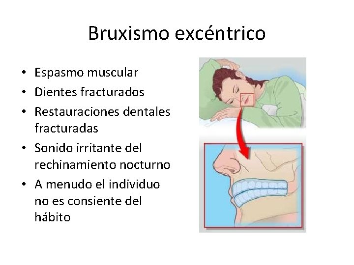 Bruxismo excéntrico • Espasmo muscular • Dientes fracturados • Restauraciones dentales fracturadas • Sonido