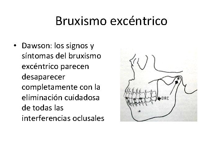 Bruxismo excéntrico • Dawson: los signos y síntomas del bruxismo excéntrico parecen desaparecer completamente