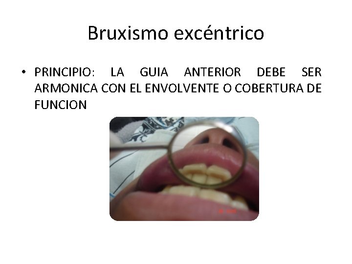 Bruxismo excéntrico • PRINCIPIO: LA GUIA ANTERIOR DEBE SER ARMONICA CON EL ENVOLVENTE O