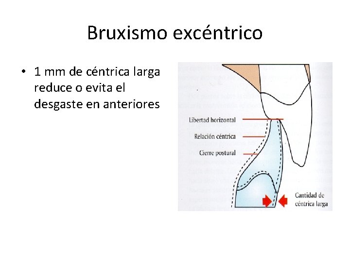Bruxismo excéntrico • 1 mm de céntrica larga reduce o evita el desgaste en