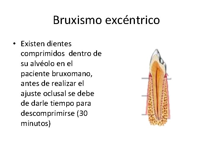 Bruxismo excéntrico • Existen dientes comprimidos dentro de su alvéolo en el paciente bruxomano,