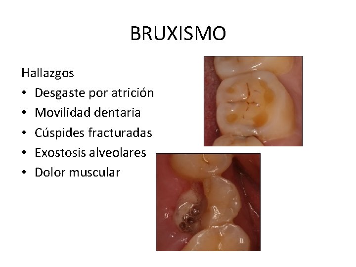 BRUXISMO Hallazgos • Desgaste por atrición • Movilidad dentaria • Cúspides fracturadas • Exostosis