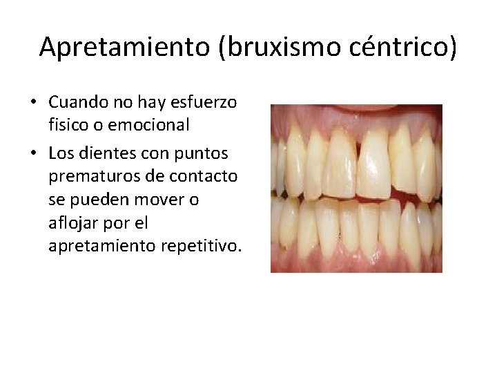 Apretamiento (bruxismo céntrico) • Cuando no hay esfuerzo fisico o emocional • Los dientes